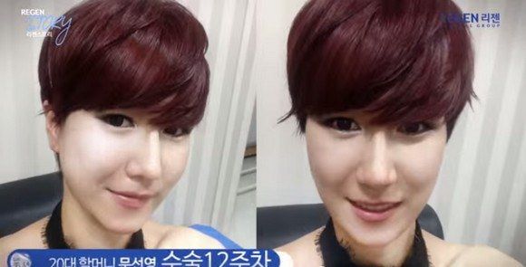 South Korean Woman Goes From Old Lady Face 4 To Dream Girl